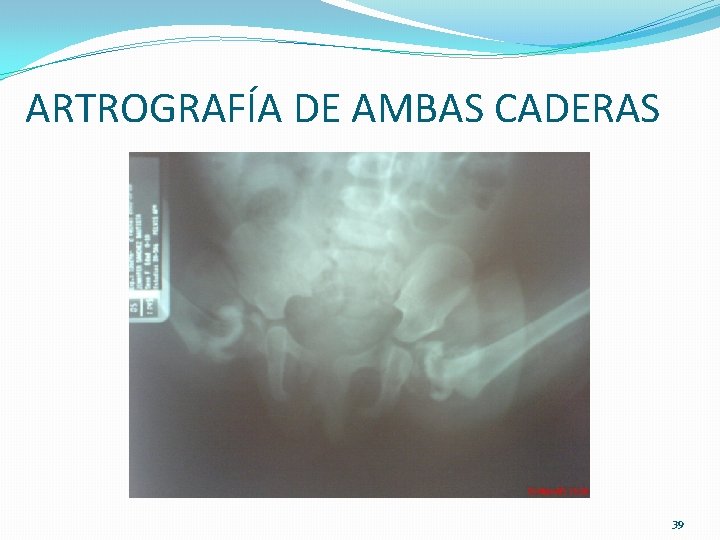 ARTROGRAFÍA DE AMBAS CADERAS 39 ARTROGRAFÍA DE AMBAS CADERAS 39