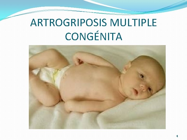 ARTROGRIPOSIS MULTIPLE CONGÉNITA 4 ARTROGRIPOSIS MULTIPLE CONGÉNITA 4