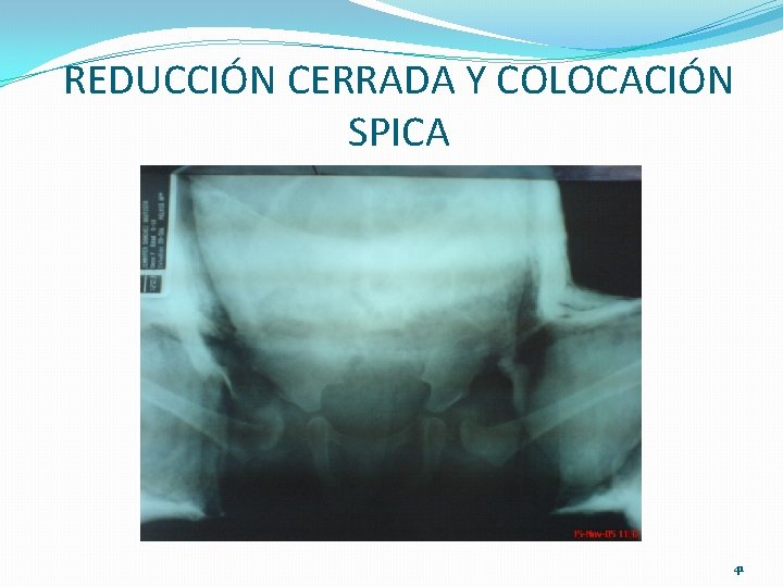 REDUCCIÓN CERRADA Y COLOCACIÓN SPICA 41 REDUCCIÓN CERRADA Y COLOCACIÓN SPICA 41