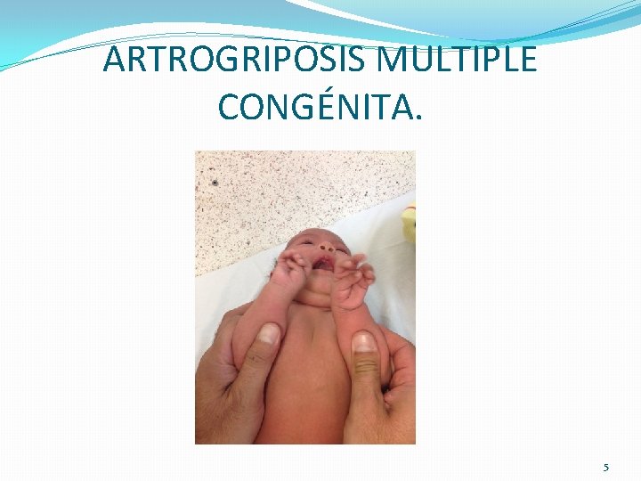 ARTROGRIPOSIS MULTIPLE CONGÉNITA. 5 ARTROGRIPOSIS MULTIPLE CONGÉNITA. 5