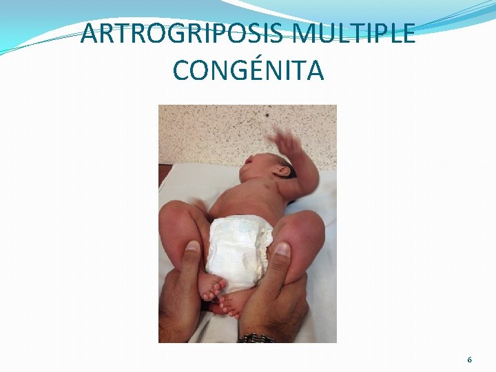 ARTROGRIPOSIS MULTIPLE CONGÉNITA 6 ARTROGRIPOSIS MULTIPLE CONGÉNITA 6