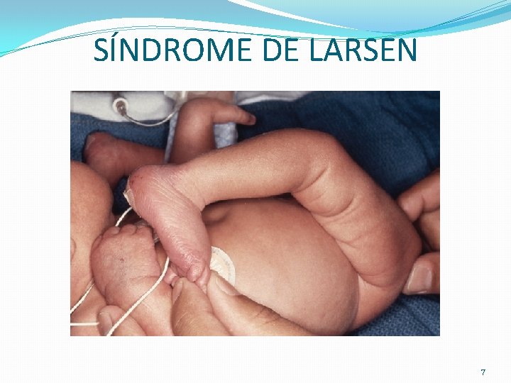 SÍNDROME DE LARSEN 7 SÍNDROME DE LARSEN 7