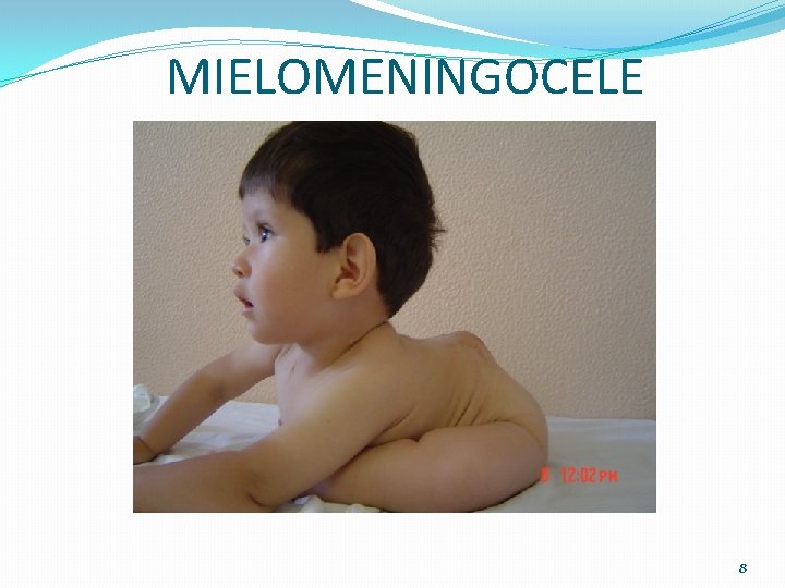 MIELOMENINGOCELE 8 MIELOMENINGOCELE 8
