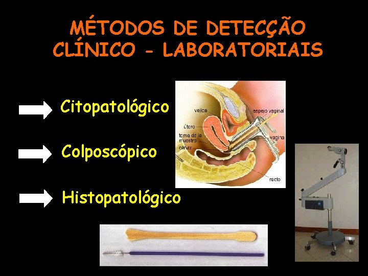 MÉTODOS DE DETECÇÃO CLÍNICO - LABORATORIAIS Citopatológico Colposcópico Histopatológico 