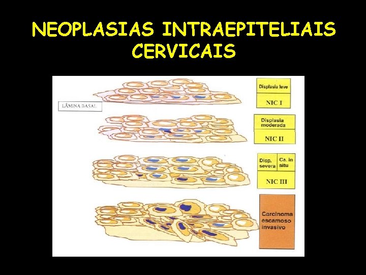 NEOPLASIAS INTRAEPITELIAIS CERVICAIS 