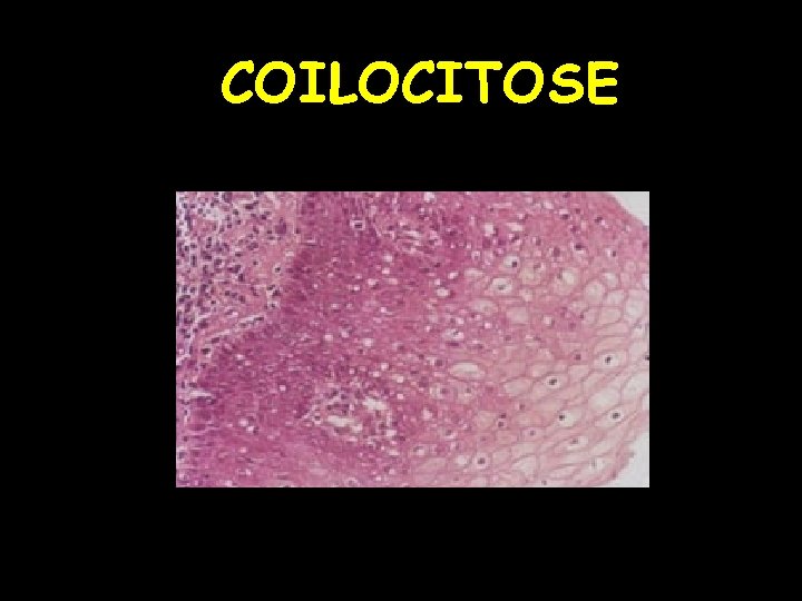 COILOCITOSE 