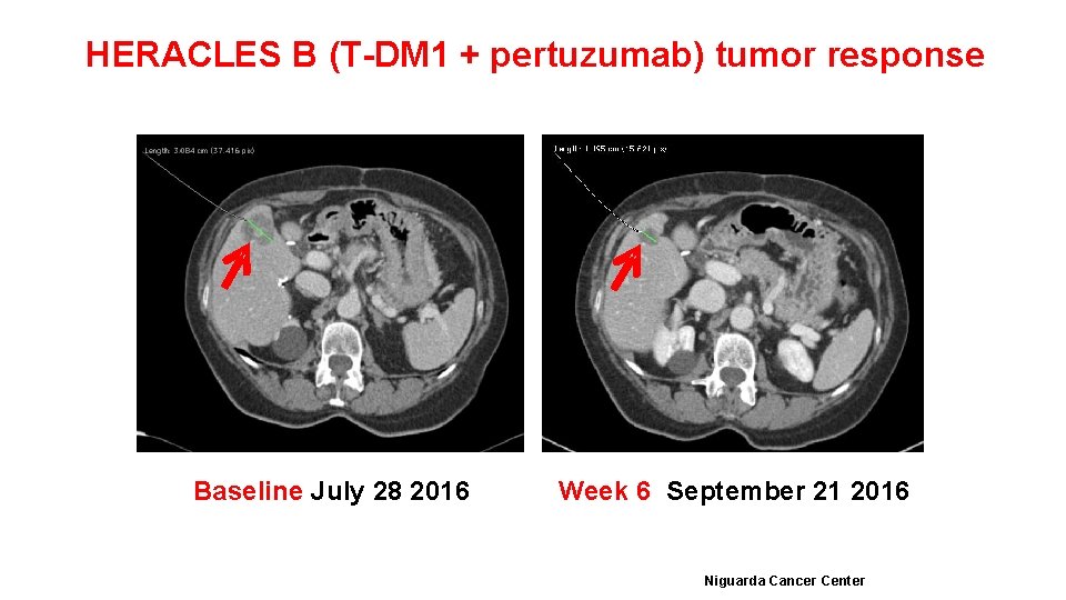 HERACLES B (T-DM 1 + pertuzumab) tumor response Baseline July 28 2016 Week 6
