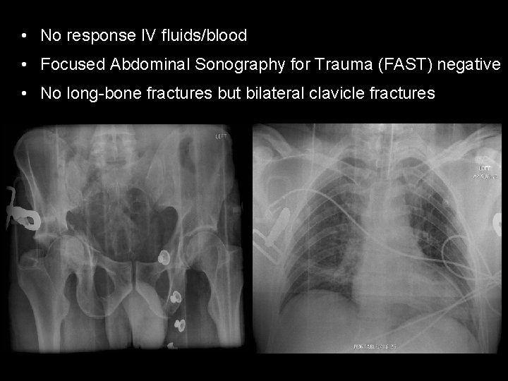  • No response IV fluids/blood • Focused Abdominal Sonography for Trauma (FAST) negative