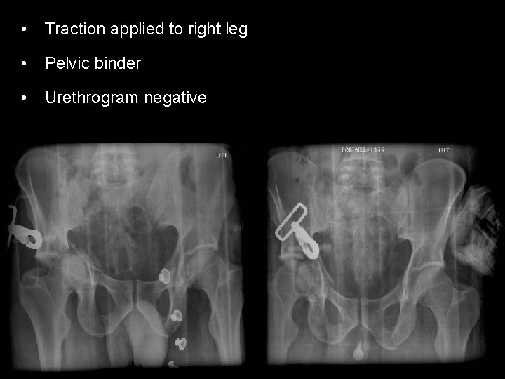  • Traction applied to right leg • Pelvic binder • Urethrogram negative 