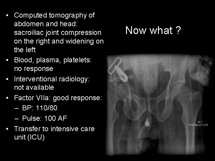  • Computed tomography of abdomen and head: sacroiliac joint compression on the right