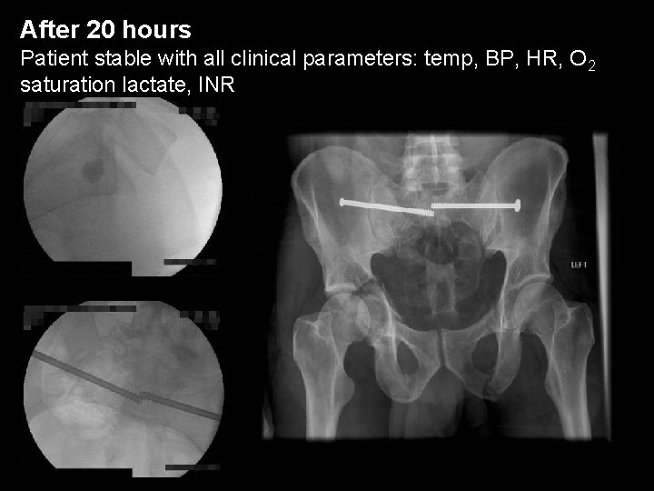 After 20 hours Patient stable with all clinical parameters: temp, BP, HR, O 2