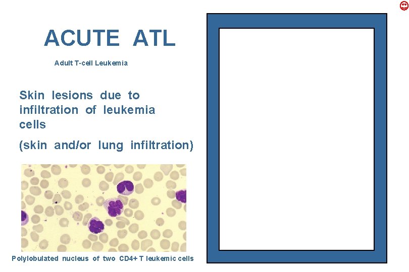 ACUTE ATL Adult T-cell Leukemia Skin lesions due to infiltration of leukemia cells (skin