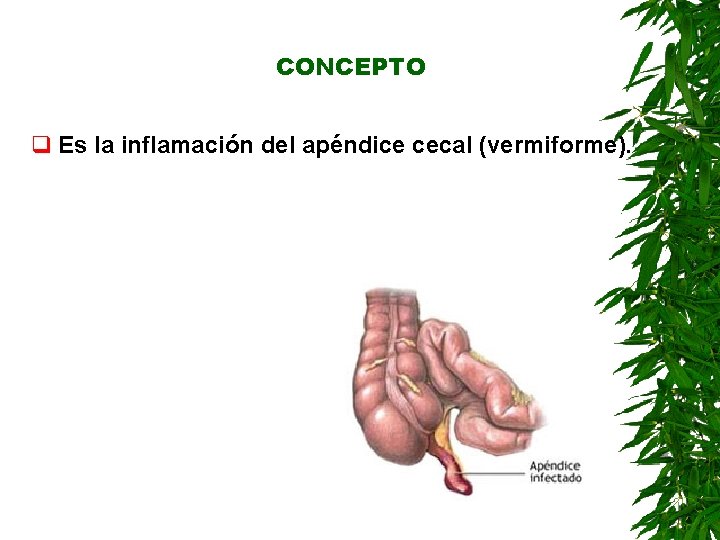 CONCEPTO q Es la inflamación del apéndice cecal (vermiforme). CONCEPTO q Es la inflamación del apéndice cecal (vermiforme).
