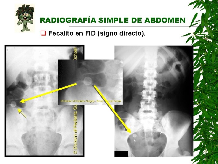 RADIOGRAFÍA SIMPLE DE ABDOMEN q Fecalito en FID (signo directo). RADIOGRAFÍA SIMPLE DE ABDOMEN q Fecalito en FID (signo directo).