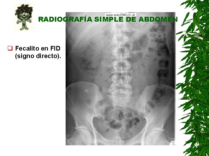 RADIOGRAFÍA SIMPLE DE ABDOMEN q Fecalito en FID (signo directo). RADIOGRAFÍA SIMPLE DE ABDOMEN q Fecalito en FID (signo directo).