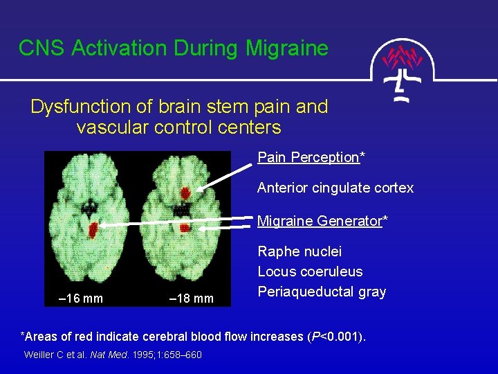 CNS Activation During Migraine Dysfunction of brain stem pain and vascular control centers Pain