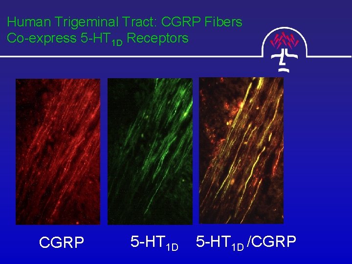 Human Trigeminal Tract: CGRP Fibers Co-express 5 -HT 1 D Receptors CGRP 5 -HT
