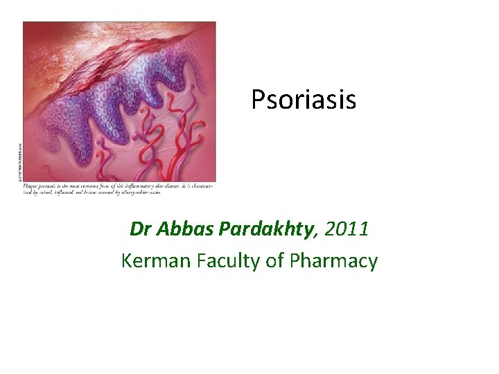 Psoriasis Dr Abbas Pardakhty, 2011 Kerman Faculty of Pharmacy 