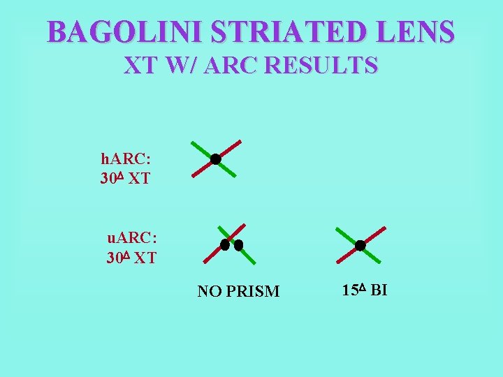 BAGOLINI STRIATED LENS XT W/ ARC RESULTS h. ARC: 30 XT u. ARC: 30