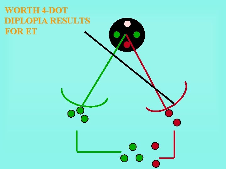 WORTH 4 -DOT DIPLOPIA RESULTS FOR ET 