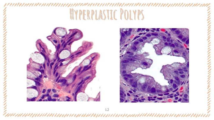 Hyperplastic Polyps 12 Hyperplastic Polyps 12
