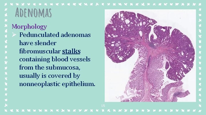 Adenomas Morphology Ø Pedunculated adenomas have slender fibromuscular stalks containing blood vessels from the Adenomas Morphology Ø Pedunculated adenomas have slender fibromuscular stalks containing blood vessels from the