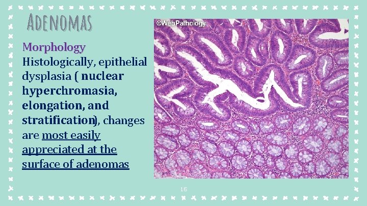 Adenomas Morphology Histologically, epithelial dysplasia ( nuclear hyperchromasia, elongation, and stratification), changes are most Adenomas Morphology Histologically, epithelial dysplasia ( nuclear hyperchromasia, elongation, and stratification), changes are most