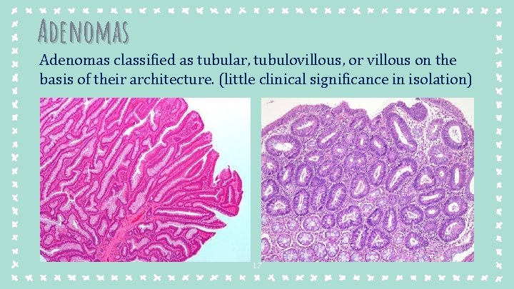 Adenomas classified as tubular, tubulovillous, or villous on the basis of their architecture. (little Adenomas classified as tubular, tubulovillous, or villous on the basis of their architecture. (little