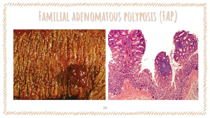Familial adenomatous polyposis (FAP) 20 Familial adenomatous polyposis (FAP) 20