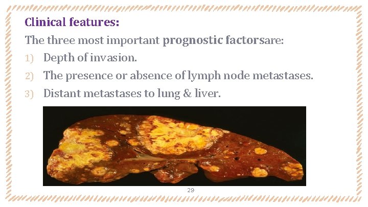 Clinical features: The three most important prognostic factorsare: 1) Depth of invasion. 2) The Clinical features: The three most important prognostic factorsare: 1) Depth of invasion. 2) The