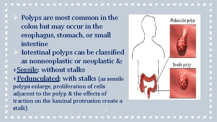 Ø Polyps are most common in the colon but may occur in the esophagus, Ø Polyps are most common in the colon but may occur in the esophagus,
