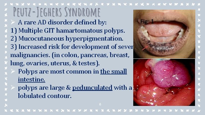 Peutz-Jeghers Syndrome Ø A rare AD disorder defined by: 1) Multiple GIT hamartomatous polyps. Peutz-Jeghers Syndrome Ø A rare AD disorder defined by: 1) Multiple GIT hamartomatous polyps.