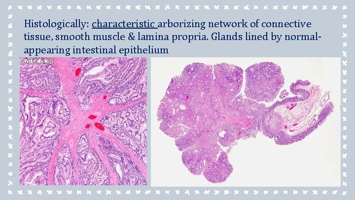 Histologically: characteristic arborizing network of connective tissue, smooth muscle & lamina propria. Glands lined Histologically: characteristic arborizing network of connective tissue, smooth muscle & lamina propria. Glands lined