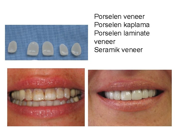 Porselen veneer Porselen kaplama Porselen laminate veneer Seramik veneer Porselen veneer Porselen kaplama Porselen laminate veneer Seramik veneer