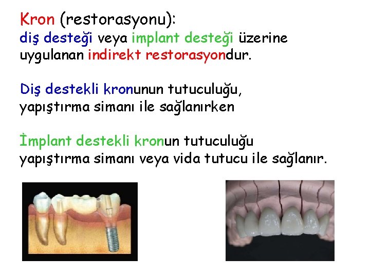 Kron (restorasyonu): diş desteği veya implant desteği üzerine uygulanan indirekt restorasyondur. Diş destekli kronunun Kron (restorasyonu): diş desteği veya implant desteği üzerine uygulanan indirekt restorasyondur. Diş destekli kronunun