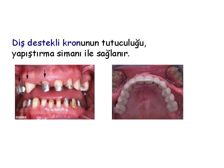 Diş destekli kronunun tutuculuğu, yapıştırma simanı ile sağlanır. Diş destekli kronunun tutuculuğu, yapıştırma simanı ile sağlanır.