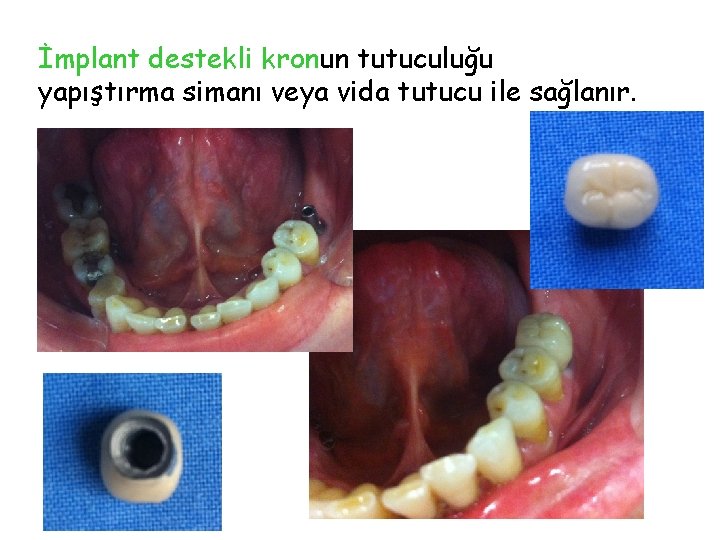 İmplant destekli kronun tutuculuğu yapıştırma simanı veya vida tutucu ile sağlanır. İmplant destekli kronun tutuculuğu yapıştırma simanı veya vida tutucu ile sağlanır.