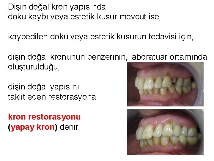 Dişin doğal kron yapısında, doku kaybı veya estetik kusur mevcut ise, kaybedilen doku veya Dişin doğal kron yapısında, doku kaybı veya estetik kusur mevcut ise, kaybedilen doku veya
