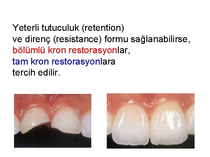 Yeterli tutuculuk (retention) ve direnç (resistance) formu sağlanabilirse, bölümlü kron restorasyonlar, tam kron restorasyonlara Yeterli tutuculuk (retention) ve direnç (resistance) formu sağlanabilirse, bölümlü kron restorasyonlar, tam kron restorasyonlara