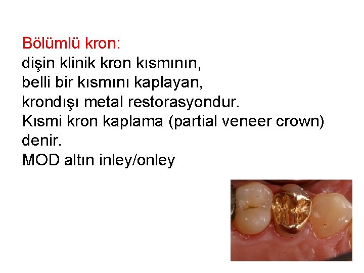 Bölümlü kron: dişin klinik kron kısmının, belli bir kısmını kaplayan, krondışı metal restorasyondur. Kısmi Bölümlü kron: dişin klinik kron kısmının, belli bir kısmını kaplayan, krondışı metal restorasyondur. Kısmi