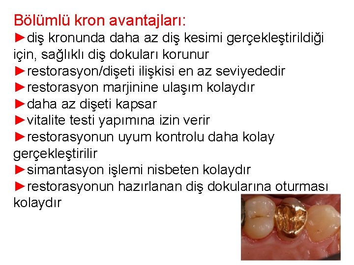 Bölümlü kron avantajları: ►diş kronunda daha az diş kesimi gerçekleştirildiği için, sağlıklı diş dokuları Bölümlü kron avantajları: ►diş kronunda daha az diş kesimi gerçekleştirildiği için, sağlıklı diş dokuları