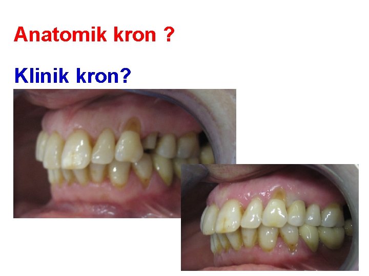 Anatomik kron ? Klinik kron? Anatomik kron ? Klinik kron?