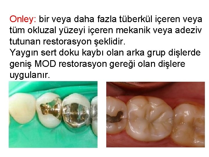 Onley: bir veya daha fazla tüberkül içeren veya tüm okluzal yüzeyi içeren mekanik veya Onley: bir veya daha fazla tüberkül içeren veya tüm okluzal yüzeyi içeren mekanik veya