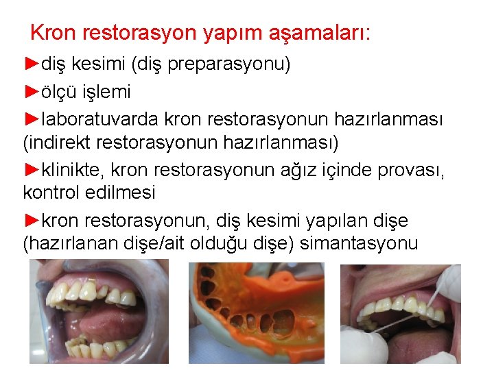 Kron restorasyon yapım aşamaları: ►diş kesimi (diş preparasyonu) ►ölçü işlemi ►laboratuvarda kron restorasyonun hazırlanması Kron restorasyon yapım aşamaları: ►diş kesimi (diş preparasyonu) ►ölçü işlemi ►laboratuvarda kron restorasyonun hazırlanması