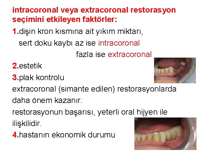 intracoronal veya extracoronal restorasyon seçimini etkileyen faktörler: 1. dişin kron kısmına ait yıkım miktarı, intracoronal veya extracoronal restorasyon seçimini etkileyen faktörler: 1. dişin kron kısmına ait yıkım miktarı,