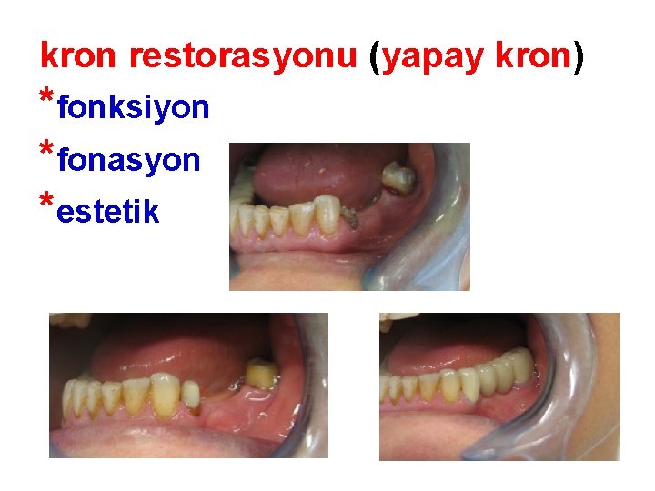 kron restorasyonu (yapay kron) *fonksiyon *fonasyon *estetik kron restorasyonu (yapay kron) *fonksiyon *fonasyon *estetik