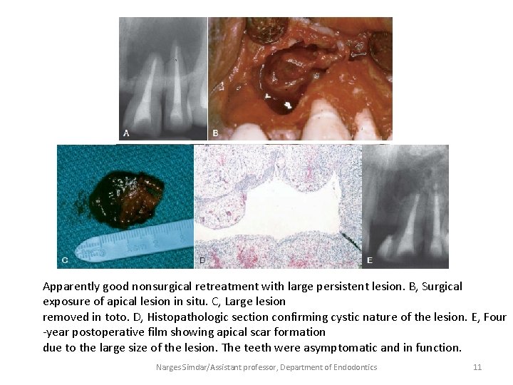 Apparently good nonsurgical retreatment with large persistent lesion. B, Surgical exposure of apical lesion