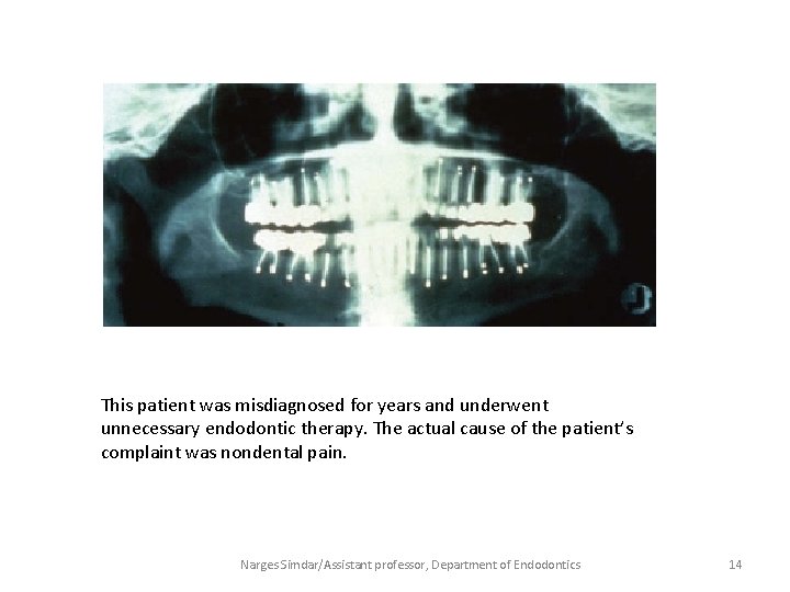 This patient was misdiagnosed for years and underwent unnecessary endodontic therapy. The actual cause