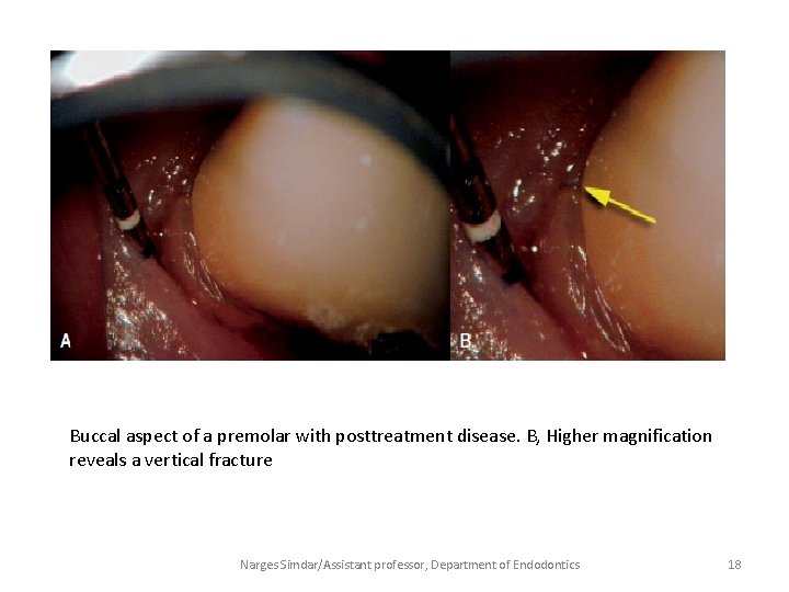 Buccal aspect of a premolar with posttreatment disease. B, Higher magnification reveals a vertical