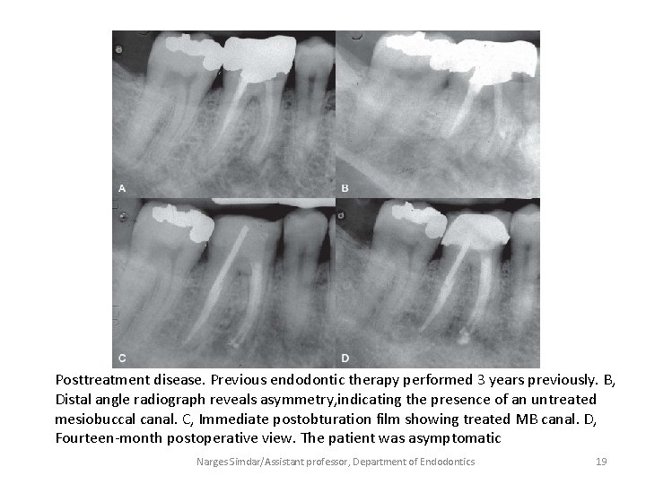 Posttreatment disease. Previous endodontic therapy performed 3 years previously. B, Distal angle radiograph reveals